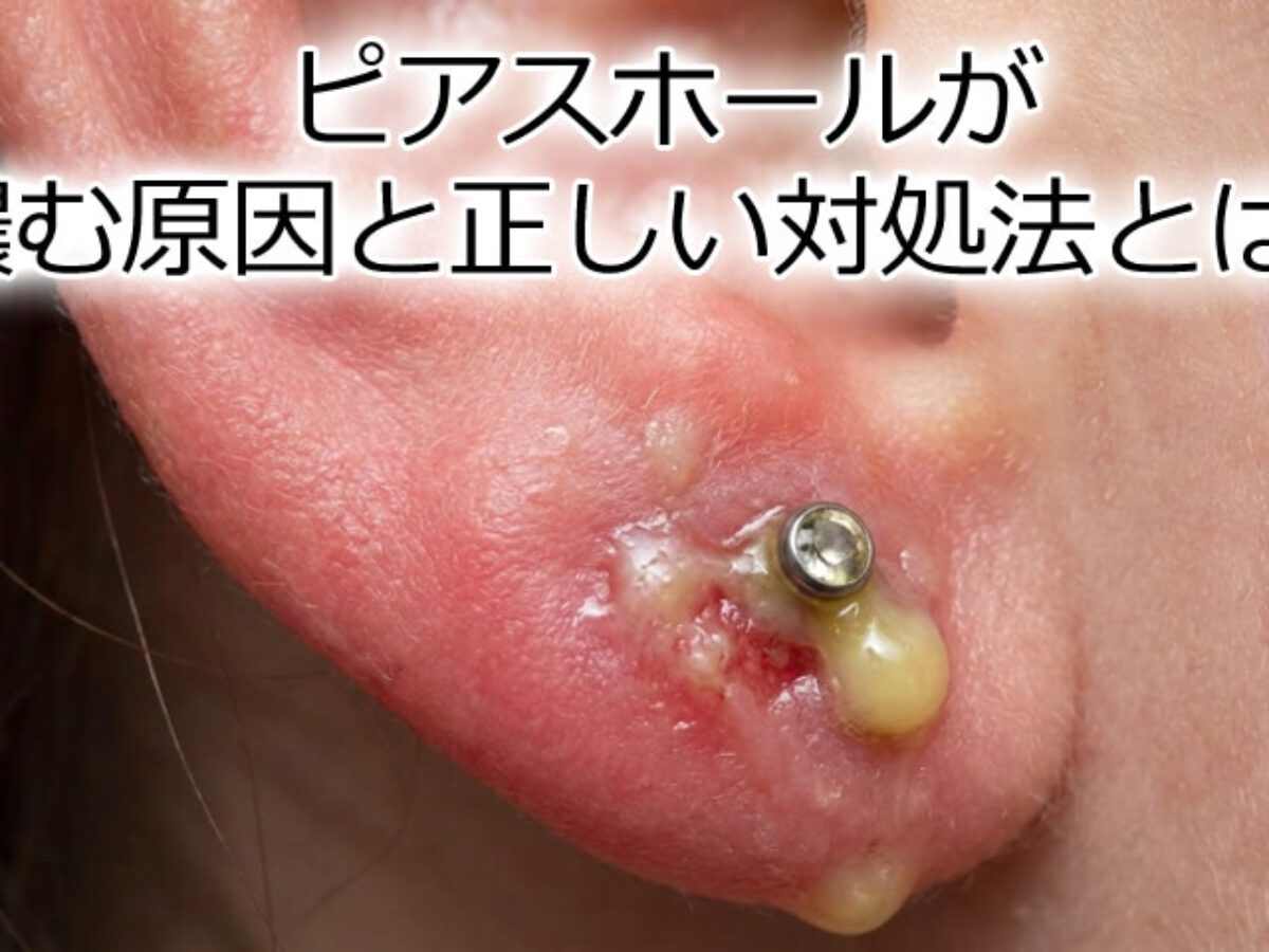 ピアス 膿む