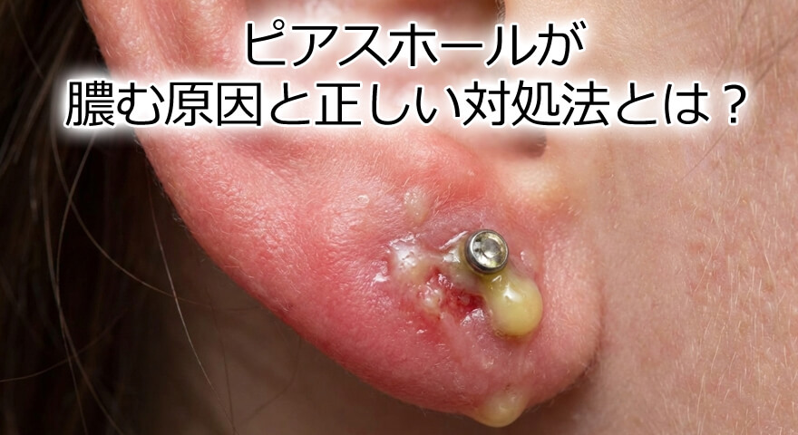 ピアスホールが膿んでジュクジュクになる原因と正しい対処法とは？