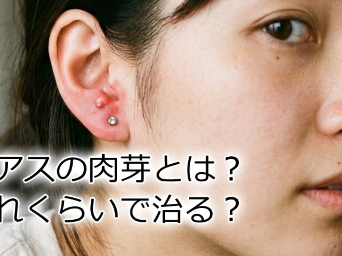 ピアス 肉芽 治し 方